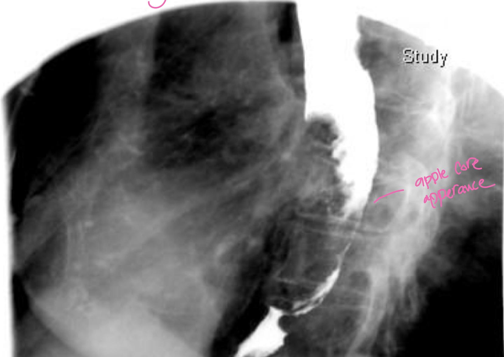 Apple Core Appearance Esophageal Cancer