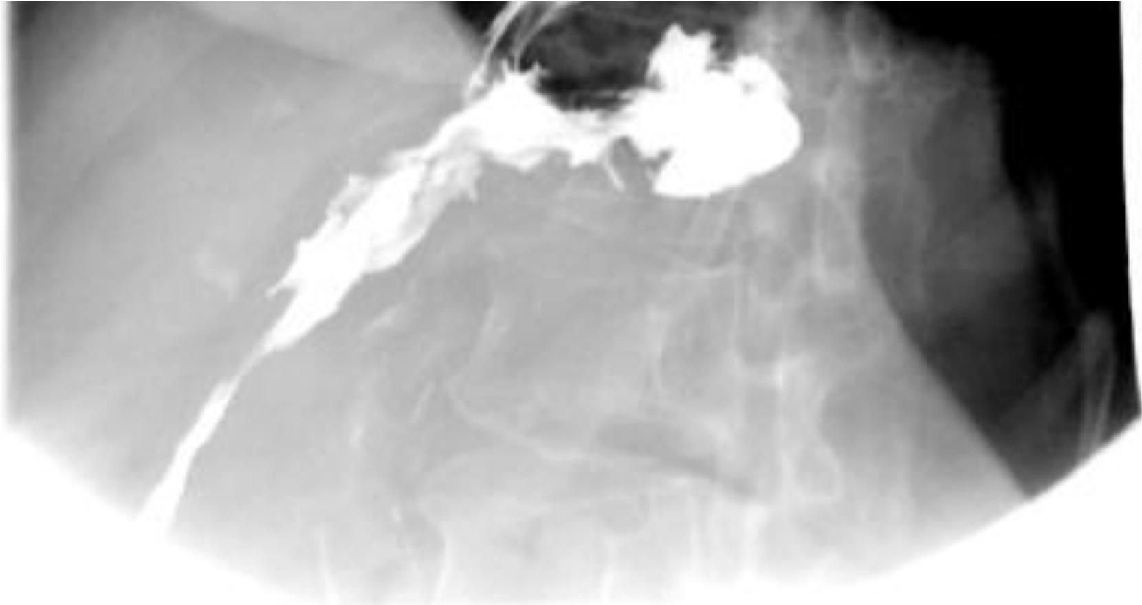 Esophageal Lesion