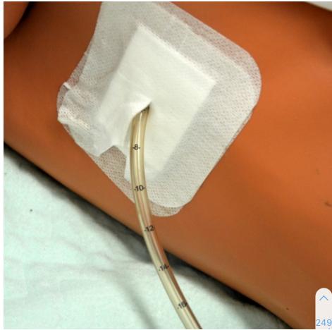 Thoracocentesis Chest Tube