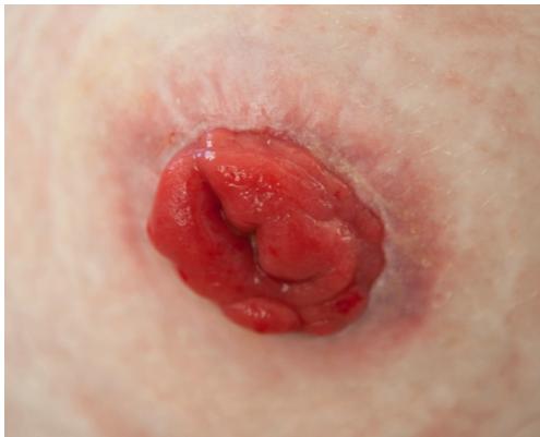 Colostomy Stoma