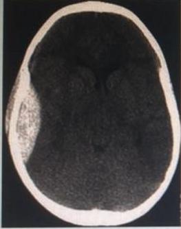 Axial CT Head Frontal Epidural Hematoma