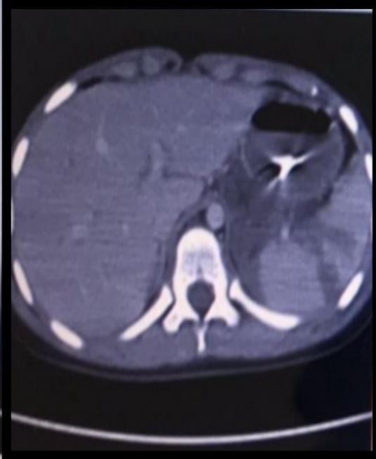 Axial CT Splenic Injury