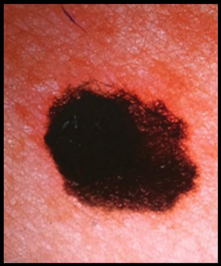 Enlarging Cutaneous Melanoma