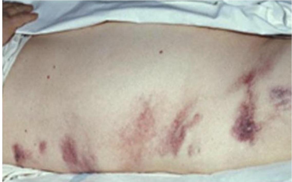 Flank Ecchymosis Grey Turner Sign