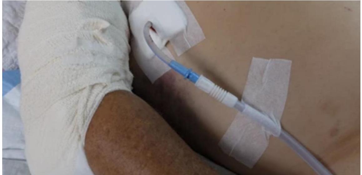 Chest Tube Secured with Tape