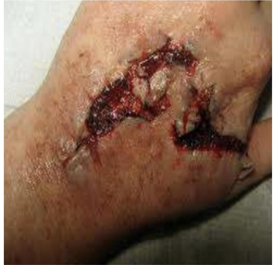 Deep Hand Laceration