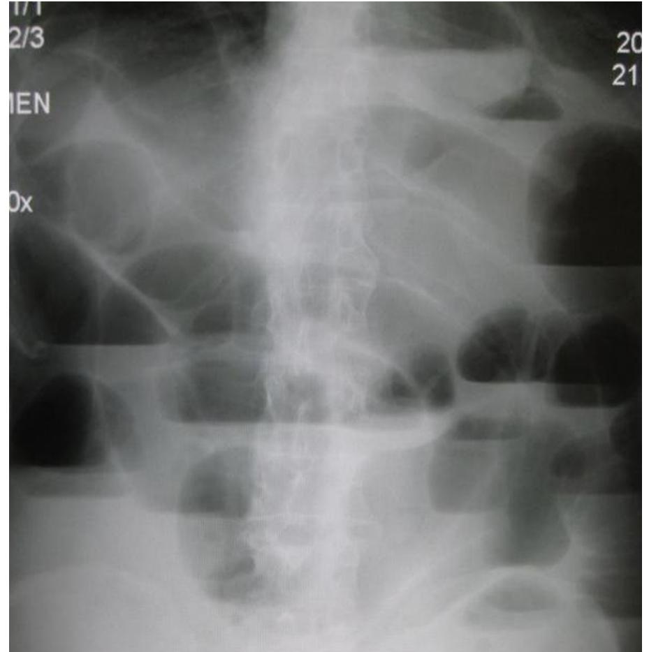 Abdominal X-Ray Bowel Obstruction