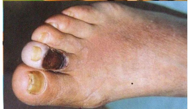 Necrotic Ulcer on Foot