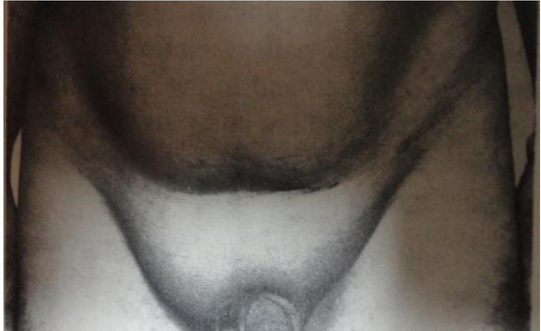 Left Inguinal Bulge
