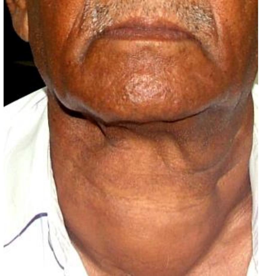 Large Anterior Neck Goiter