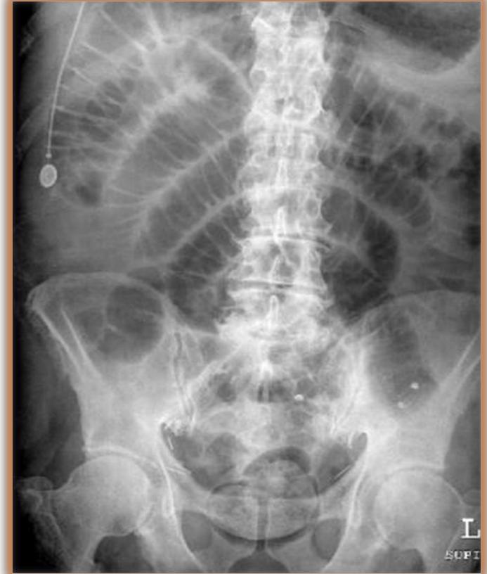 Abdominal X-Ray Large Bowel Obstruction
