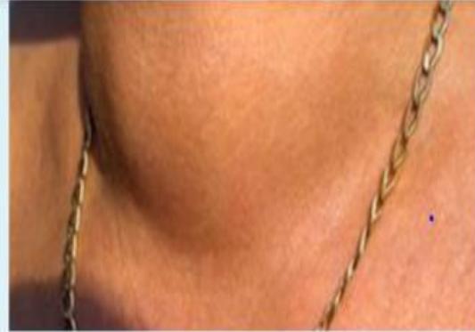 Neck Swelling Clinical Photo