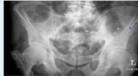 Dilated Small Bowel Loops X-Ray