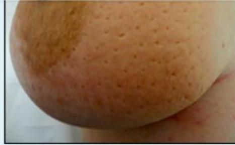 Breast Peau d Orange and Nipple Retraction