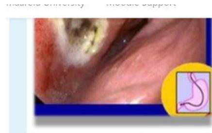 Endoscopic View Duodenal Ulcer