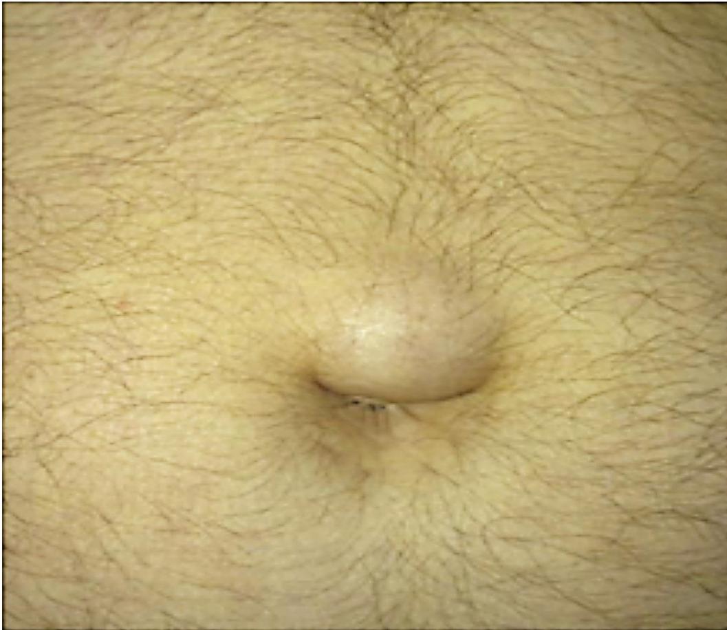 Paraumbilical Hernia Male Abdomen Close-up