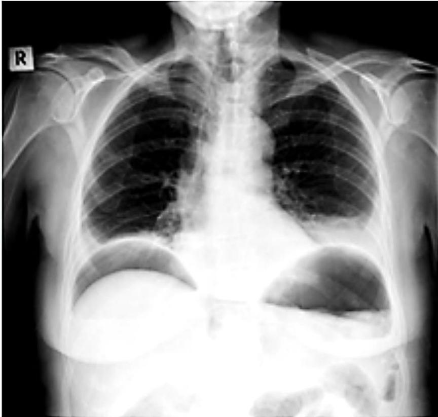 Erect CXR Bilateral Pneumoperitoneum