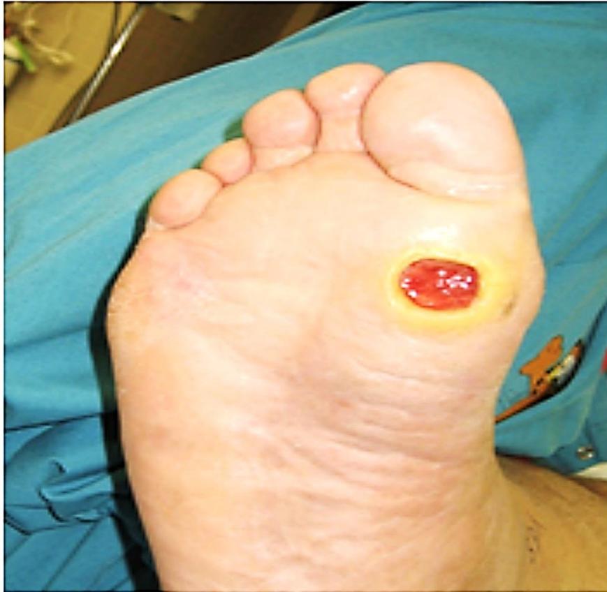 Plantar Surface Ulcer Below Big Toe