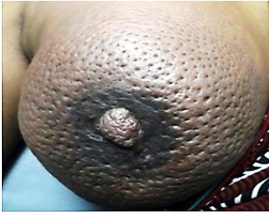 Firm Right Breast Lump