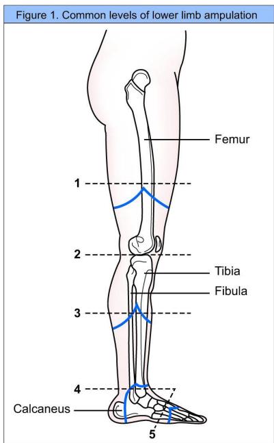 Amputation levels