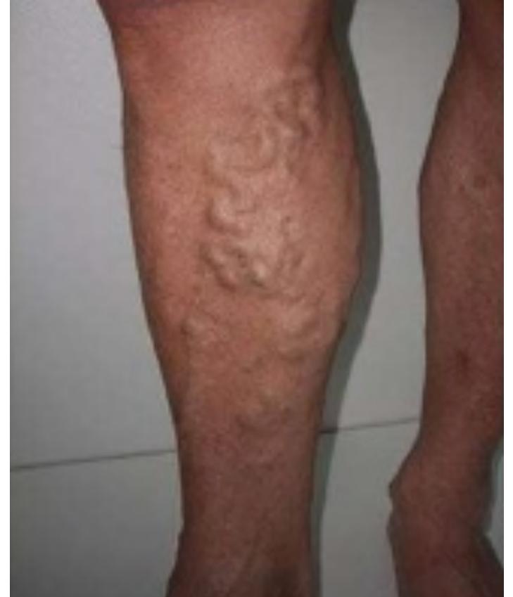 Leg varicosities