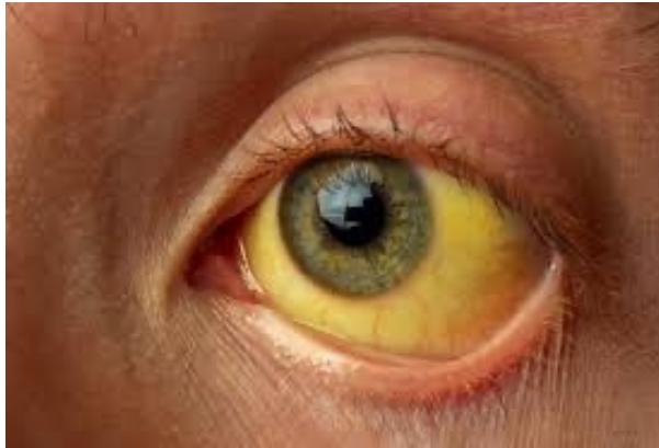 Scleral icterus