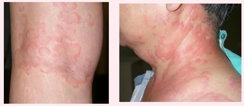 Derma-OSBE-064e756084bd79da.webp|299x130