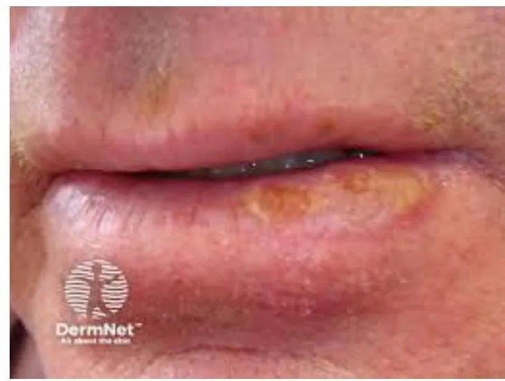 Derma-OSBE-8b100f97cce2687a.webp|218x165