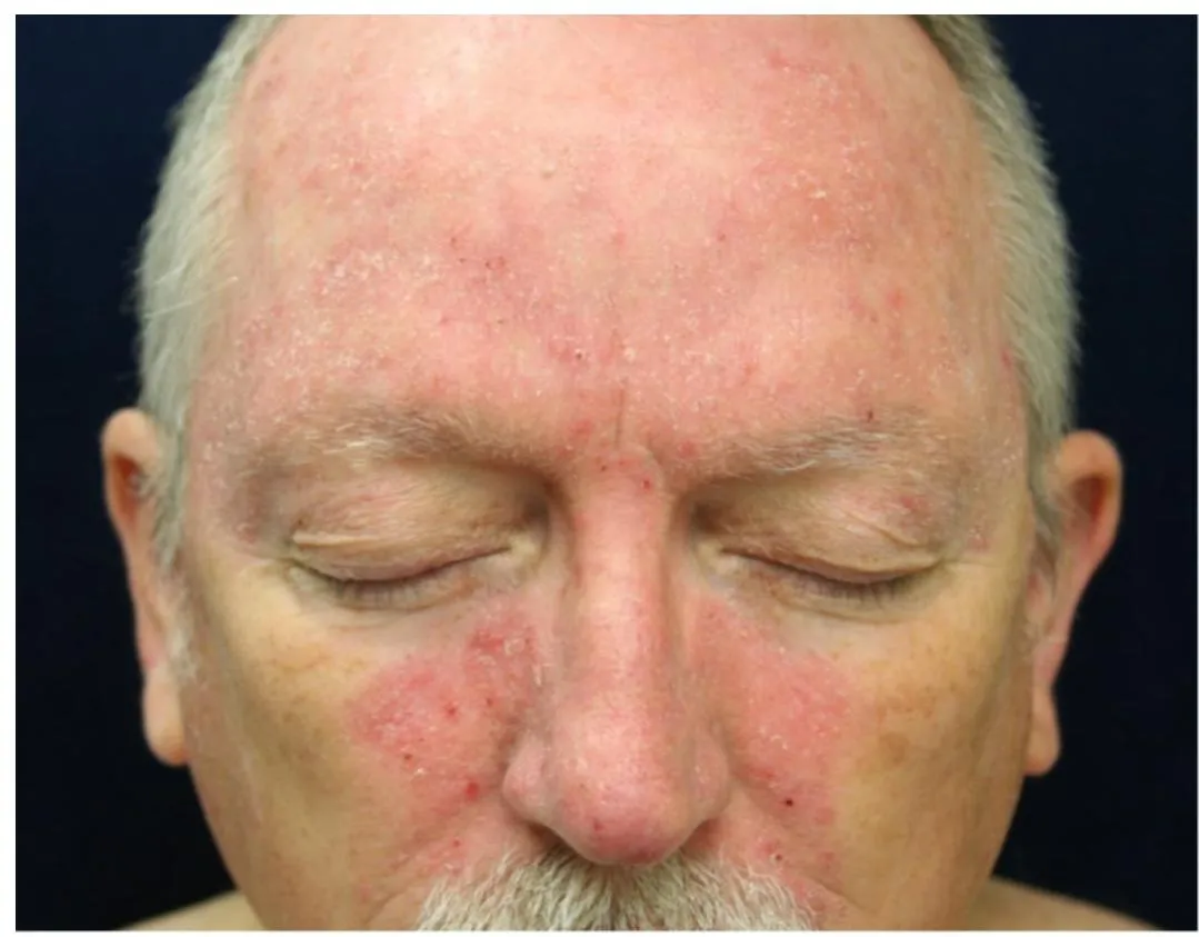 Derma-OSBE-bf200f47740a5cce.webp|179x185