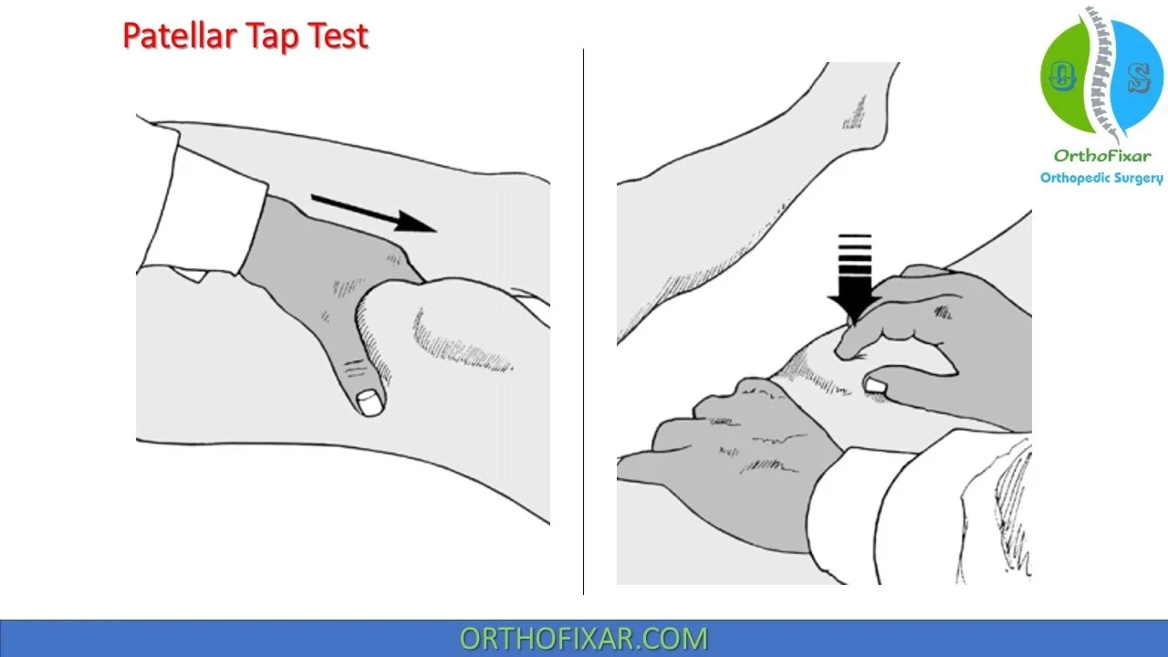 Patellar Tap Test