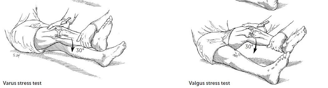 Varus Stress Test Example