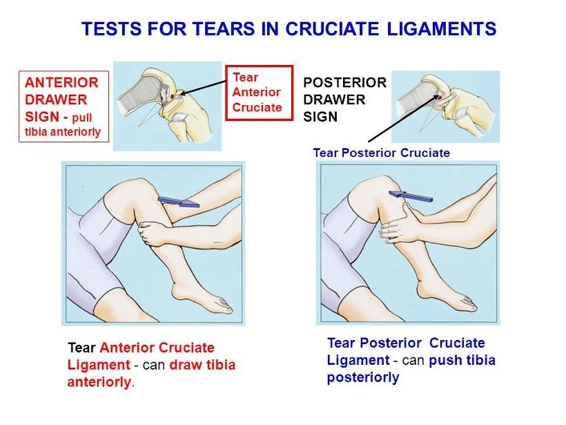 Anterior & Posterior Drawer Tests