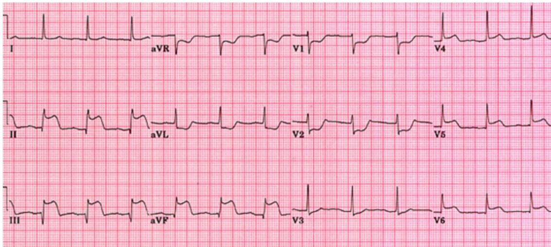 ECG Figure 2