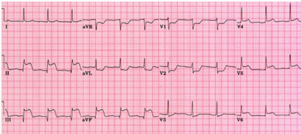 ECG Figure 1