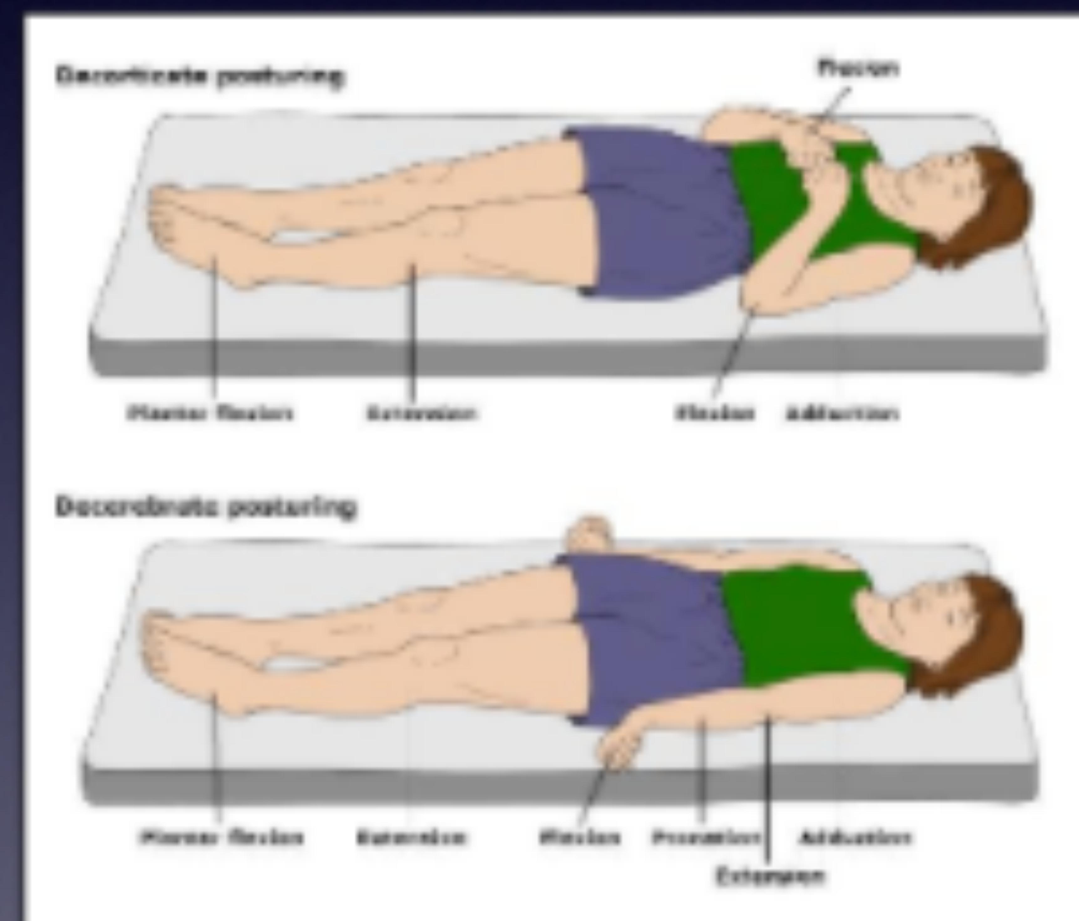 Decorticate vs Decerebrate