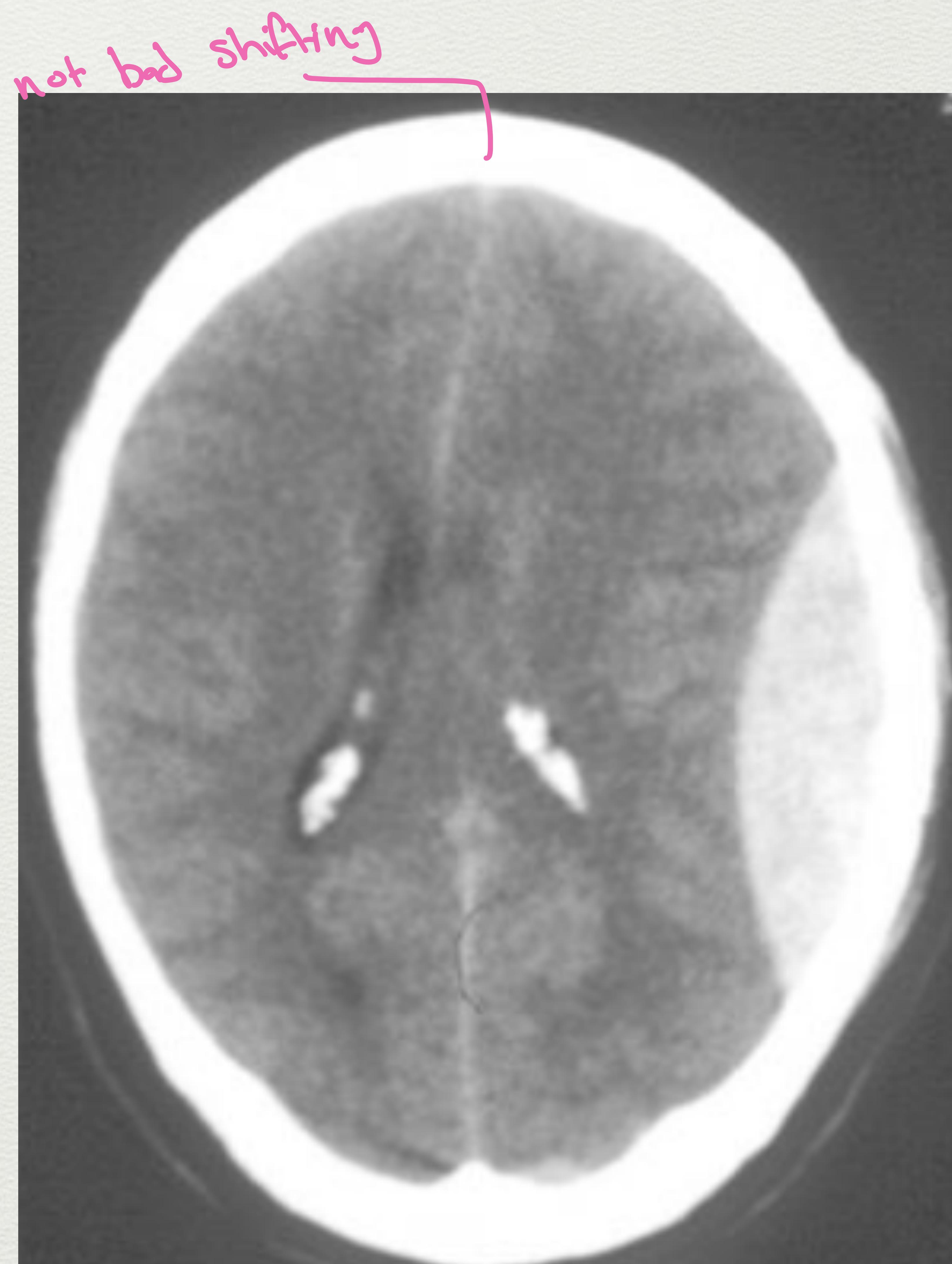 Epidural Hematoma