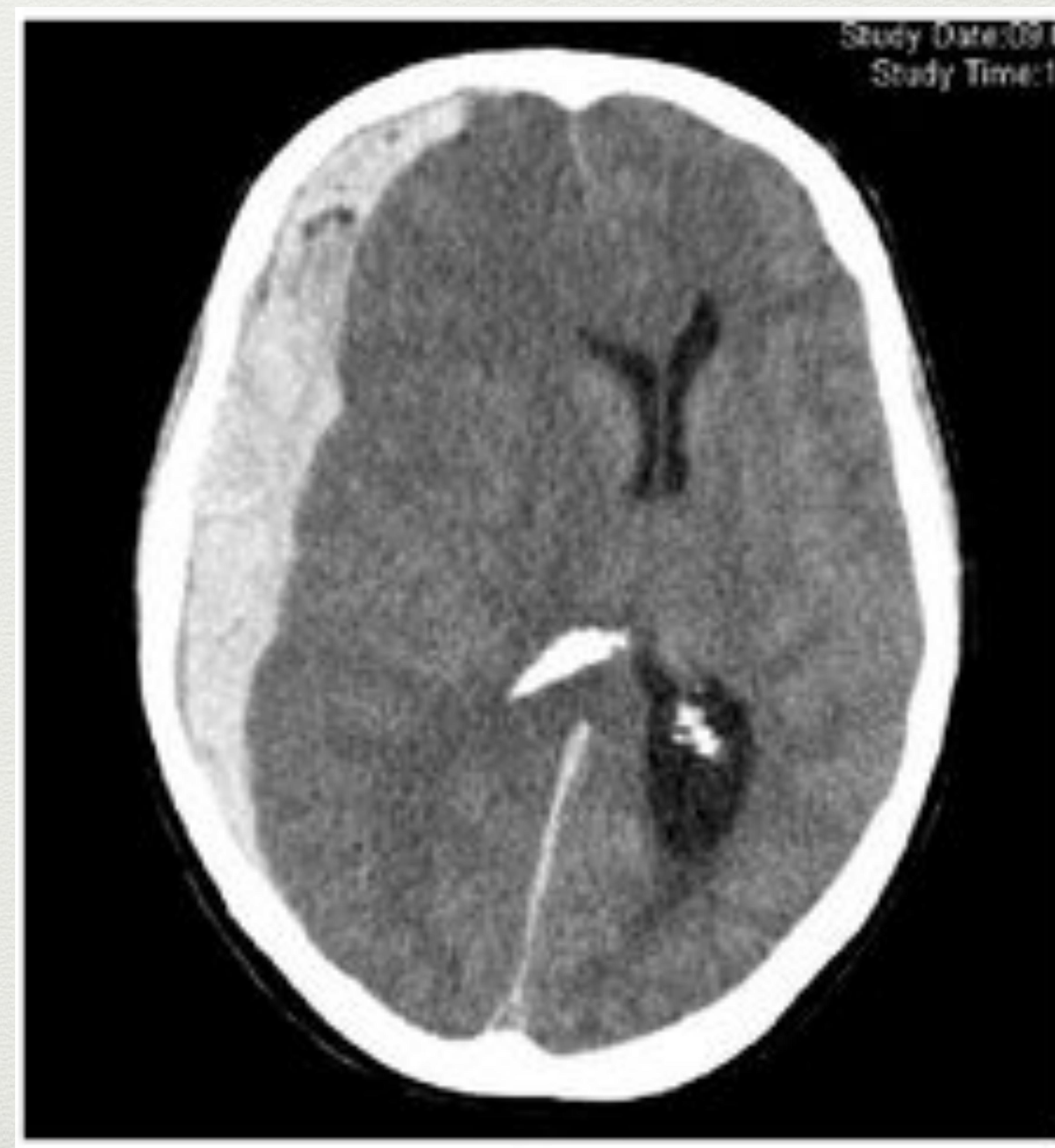 Subdural Haematoma