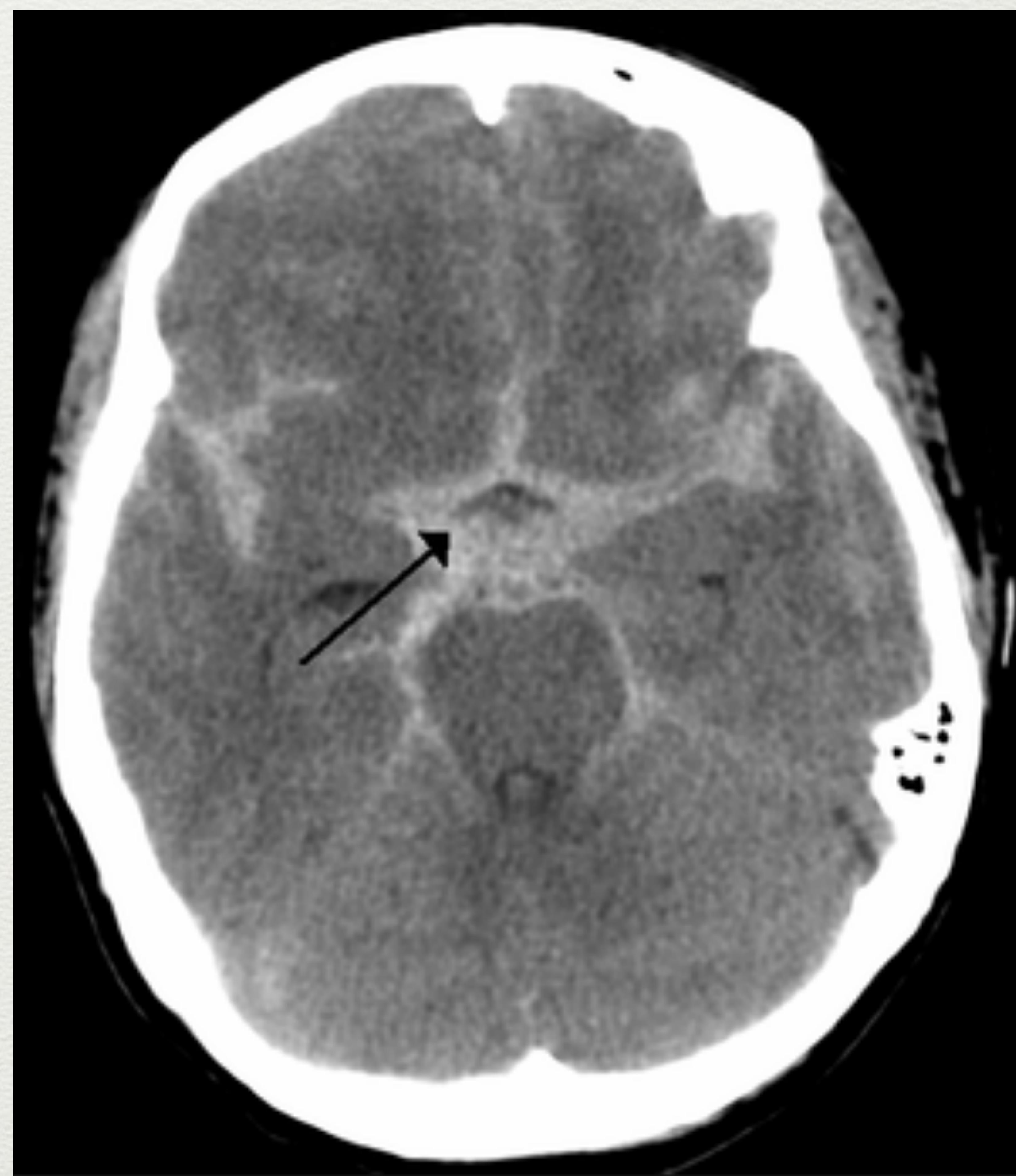 Subarachnoid Haematoma