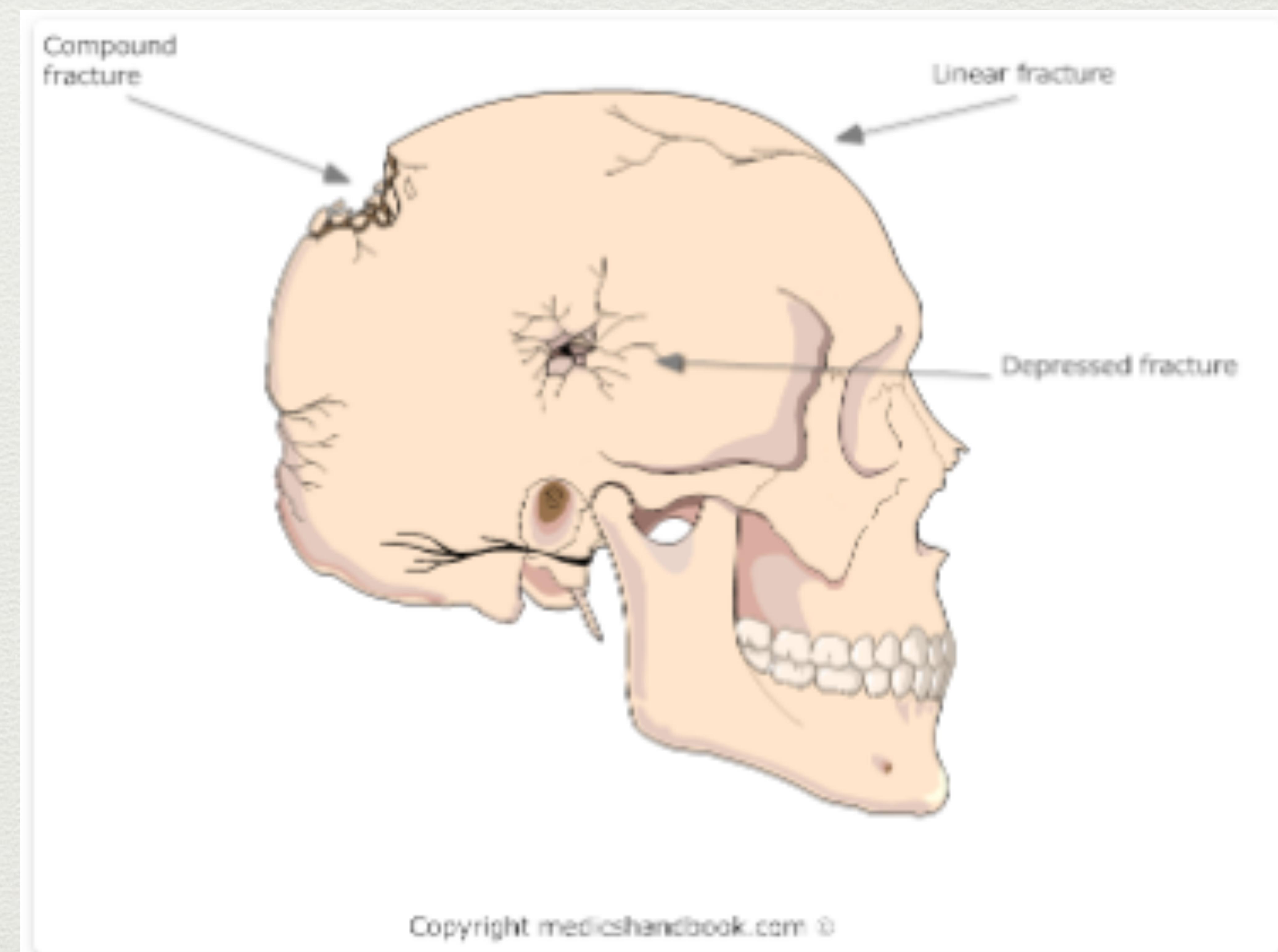 Skull Fracture Types