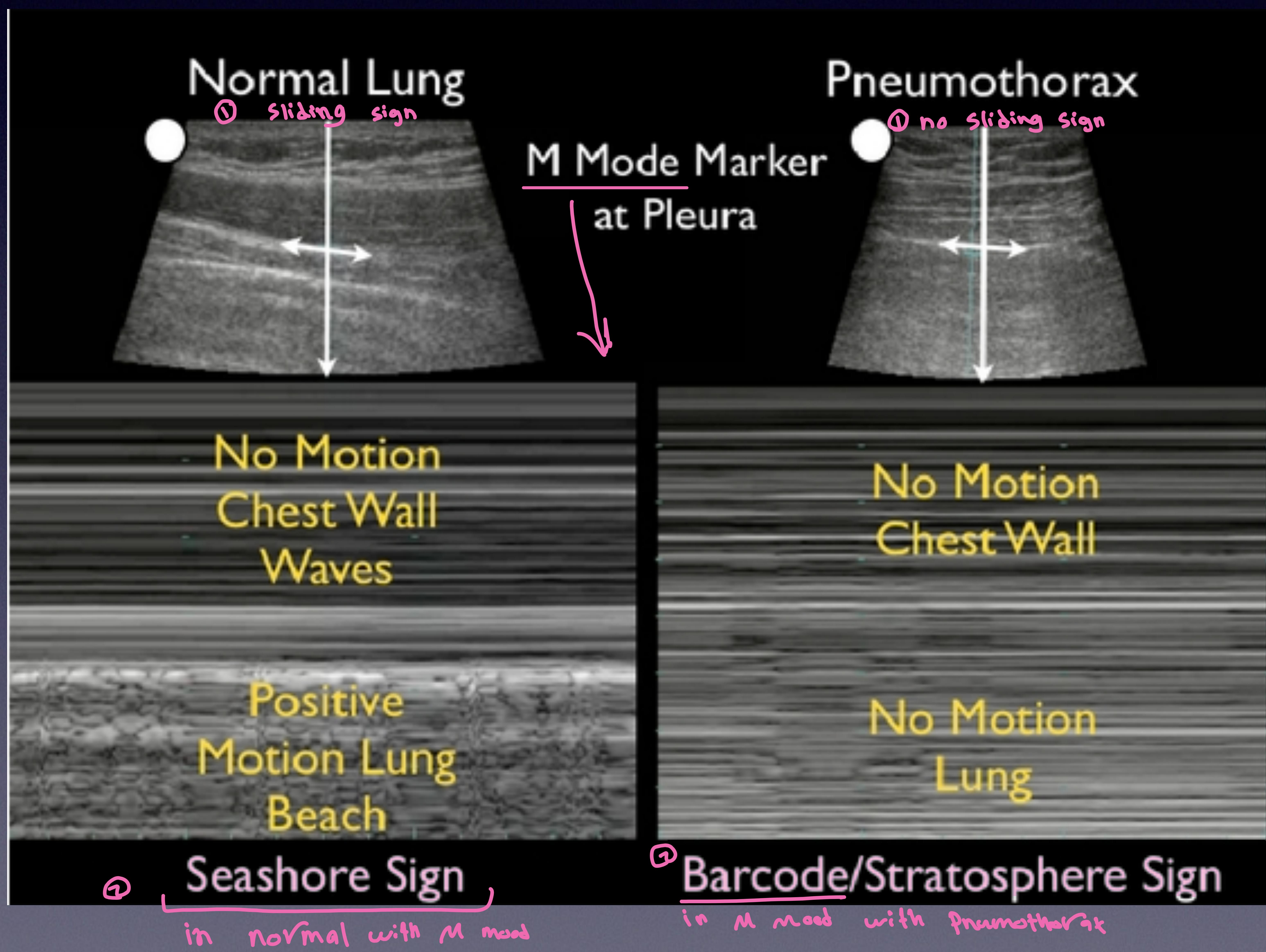 Lung Scan M-Mode
