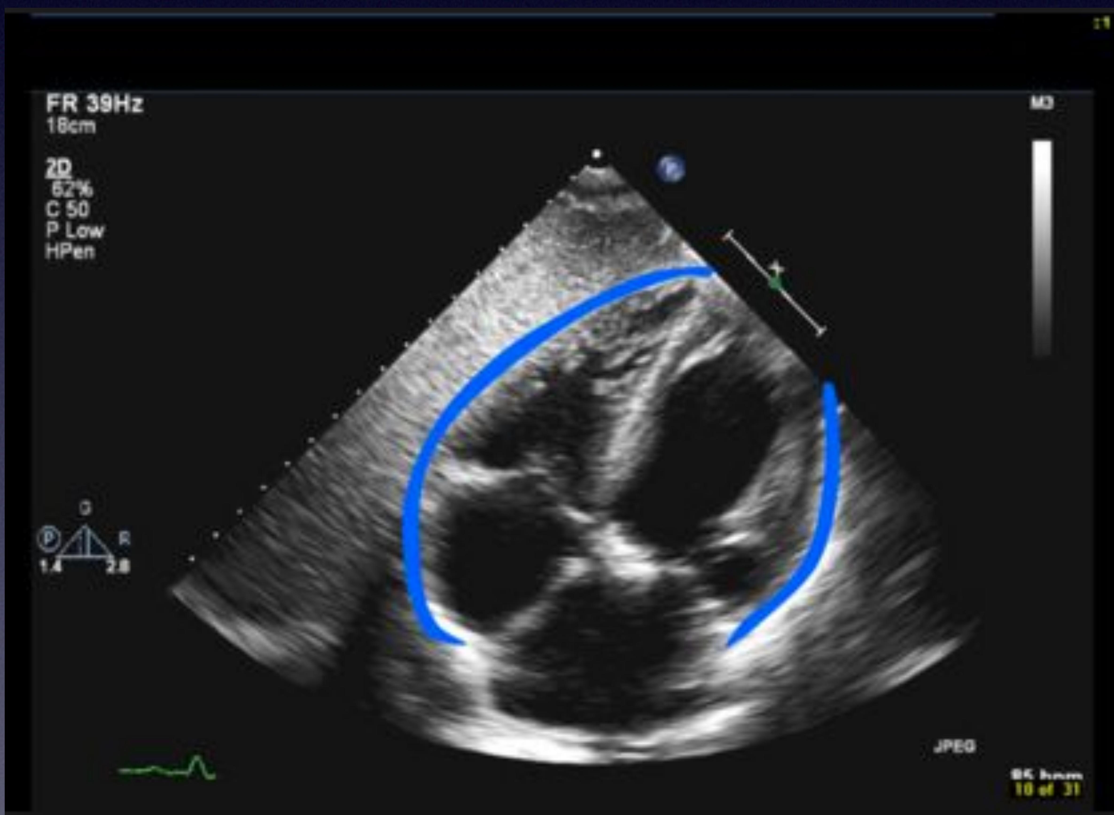 Pericardial Effusion