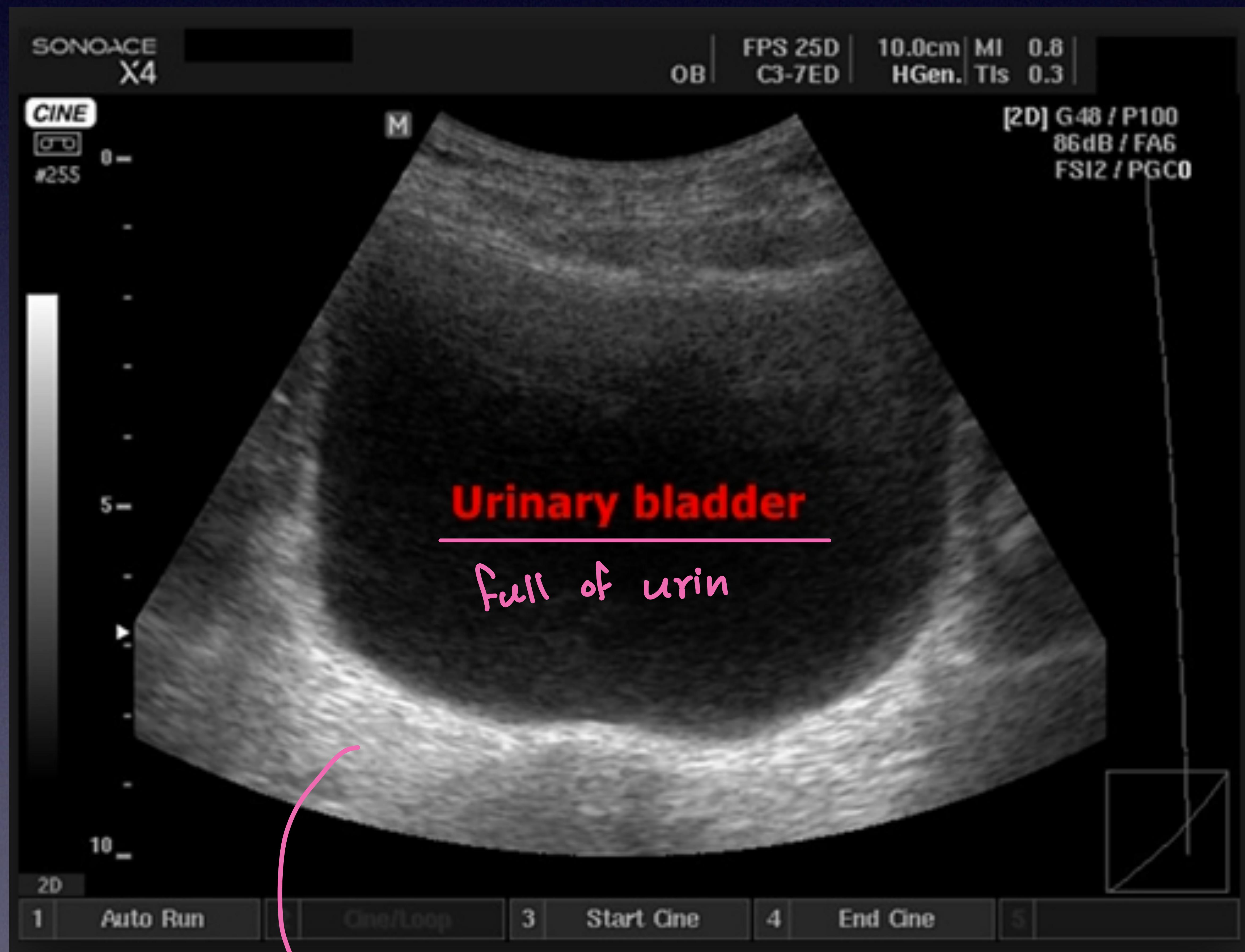 Normal Bladder