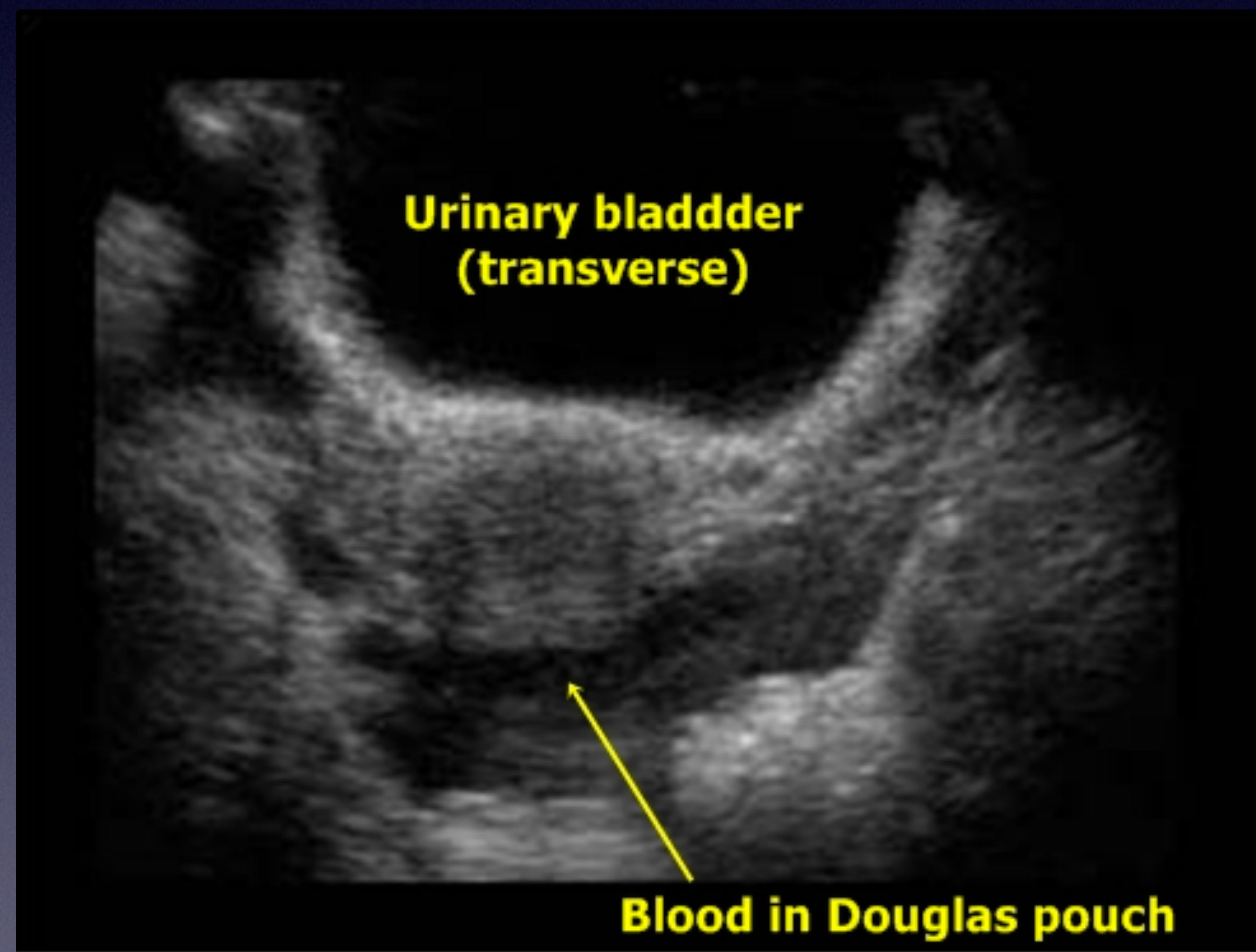 Abnormal Bladder