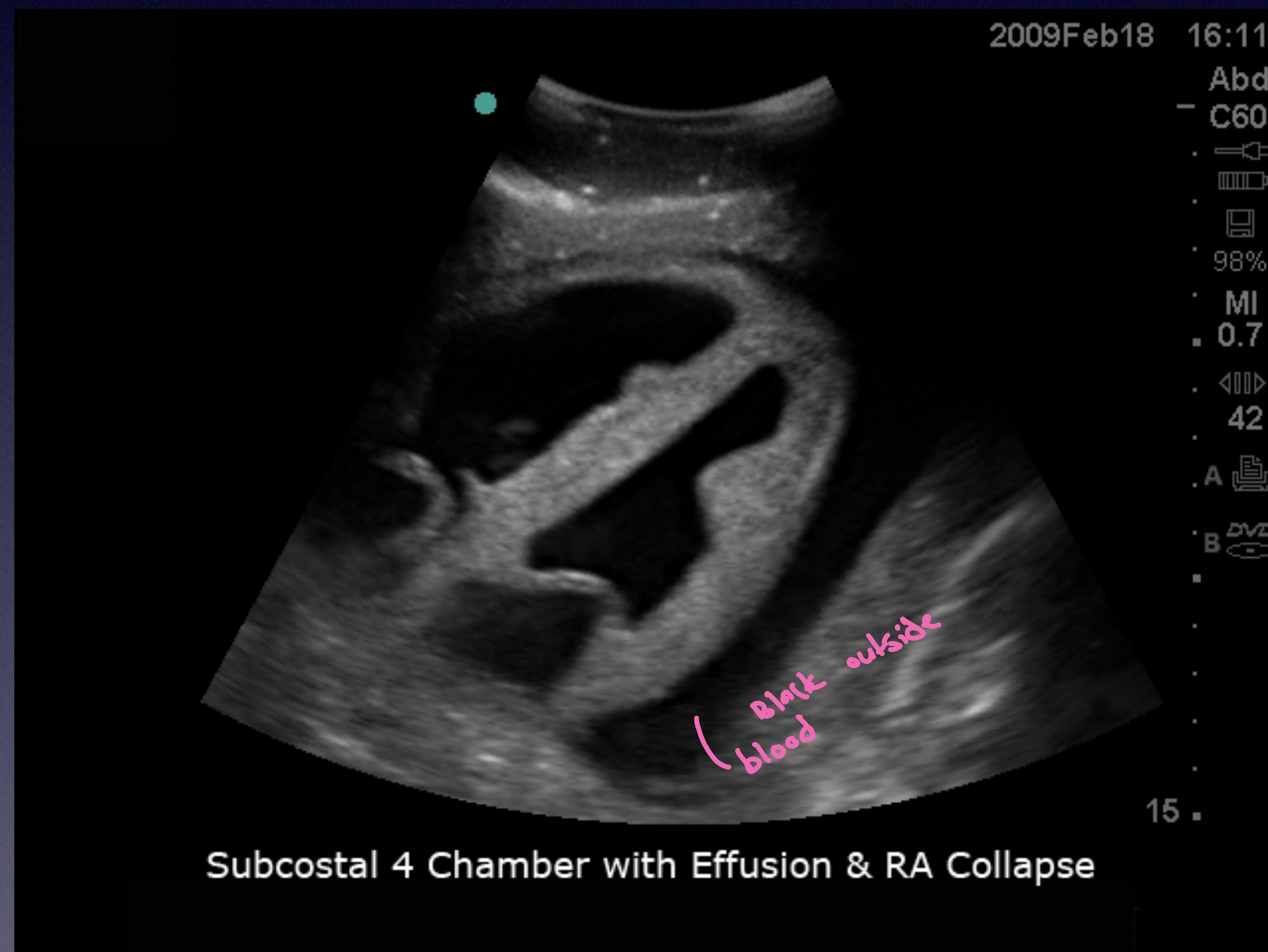Pericardial Tamponade