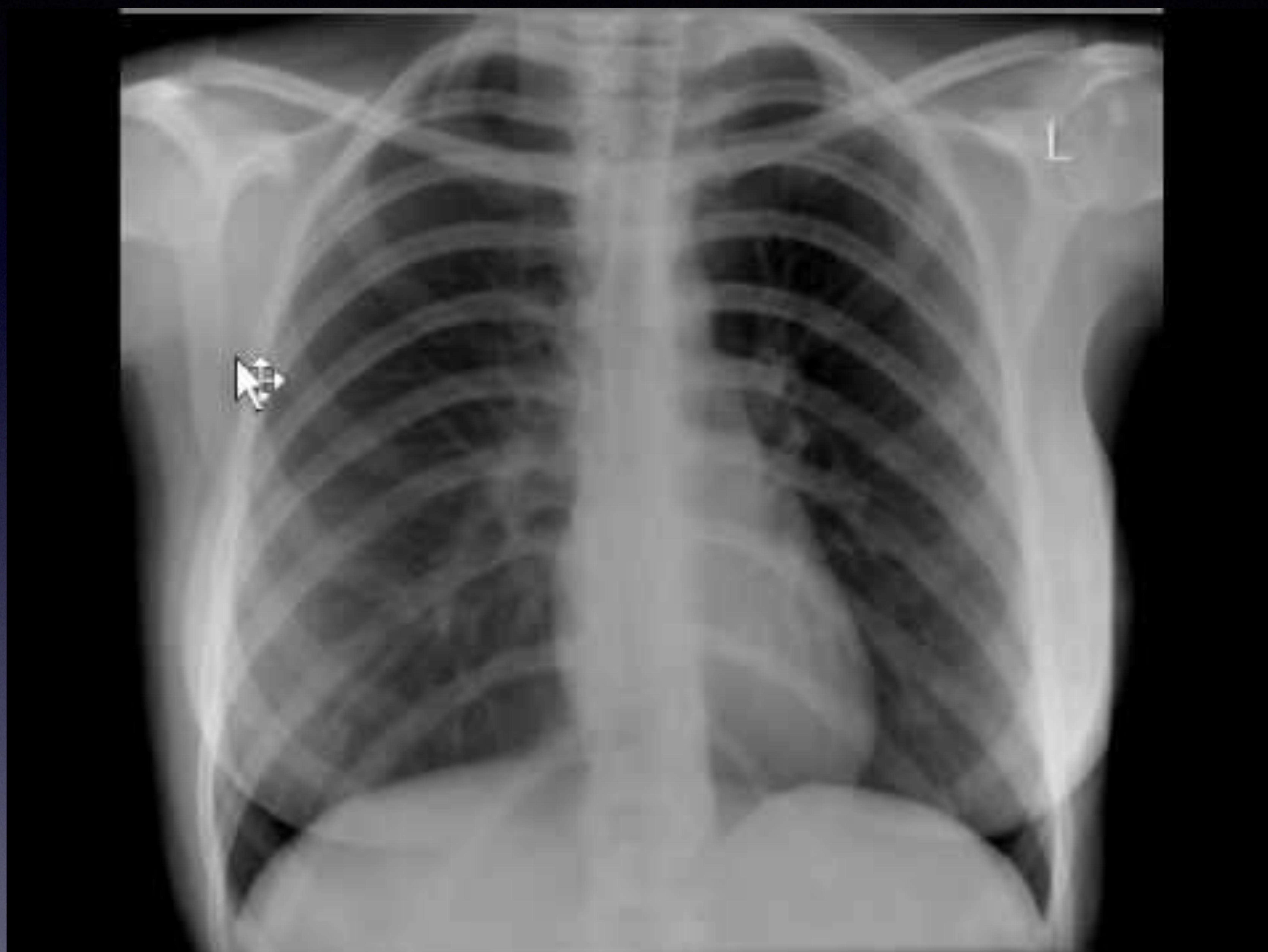 Chest X-ray