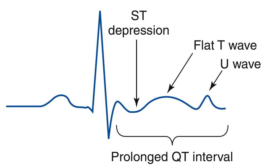Hypokalemia ECG