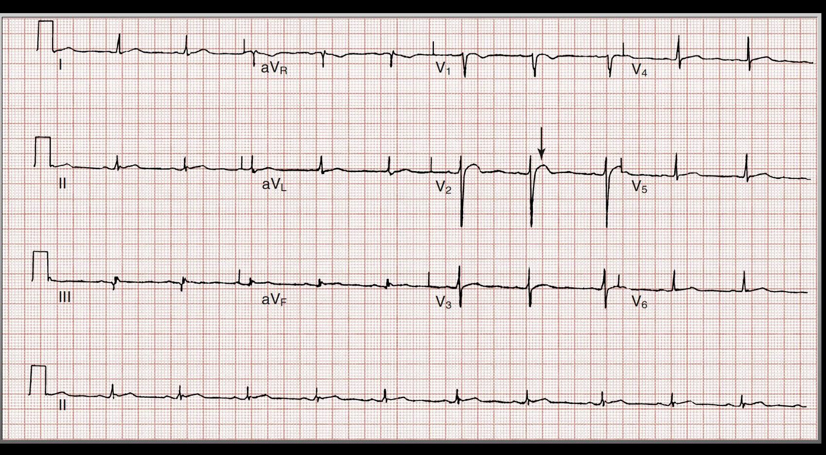 Hypercalcemia ECG/images