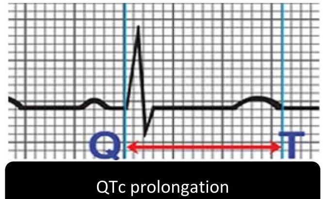 ECG Hypocalcemia