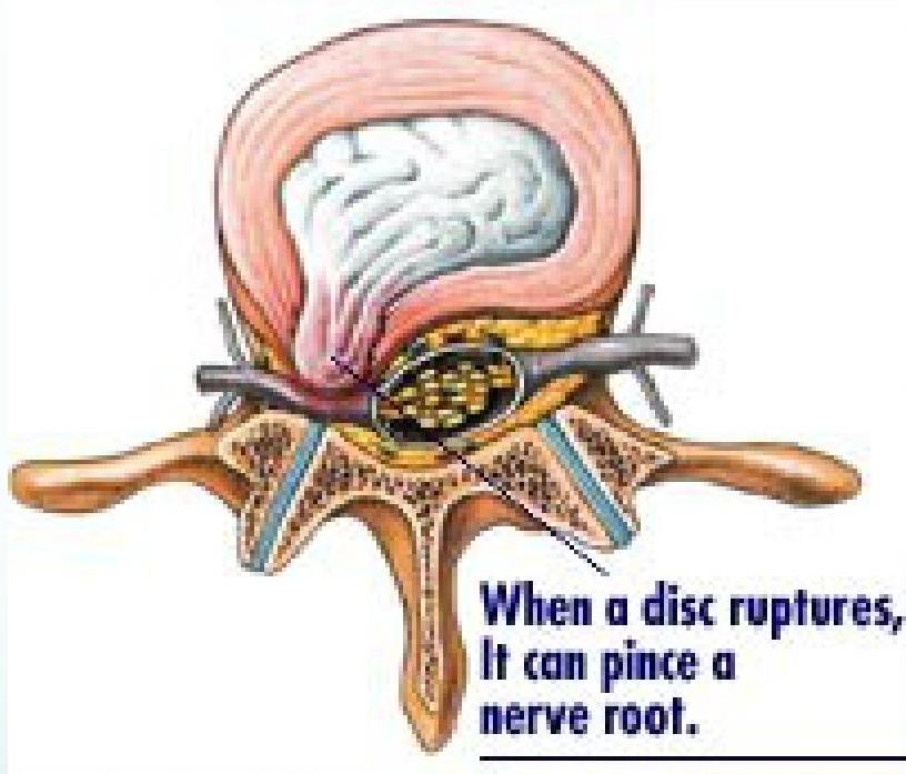 Low back pain img-10