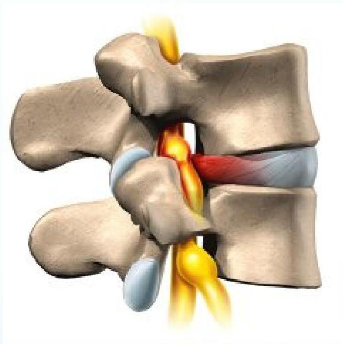 Low back pain img-11